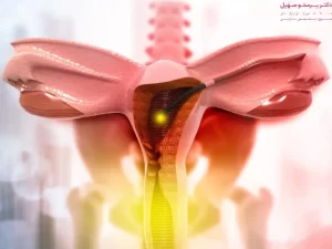 بارداری بعد از هیستروسکوپی