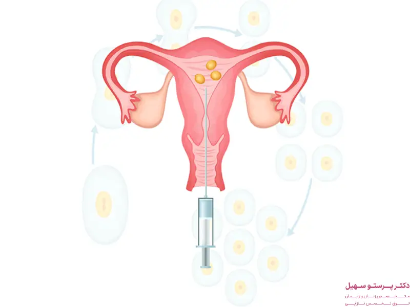 هزینه آی یو آی