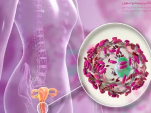 عفونت قارچی واژن