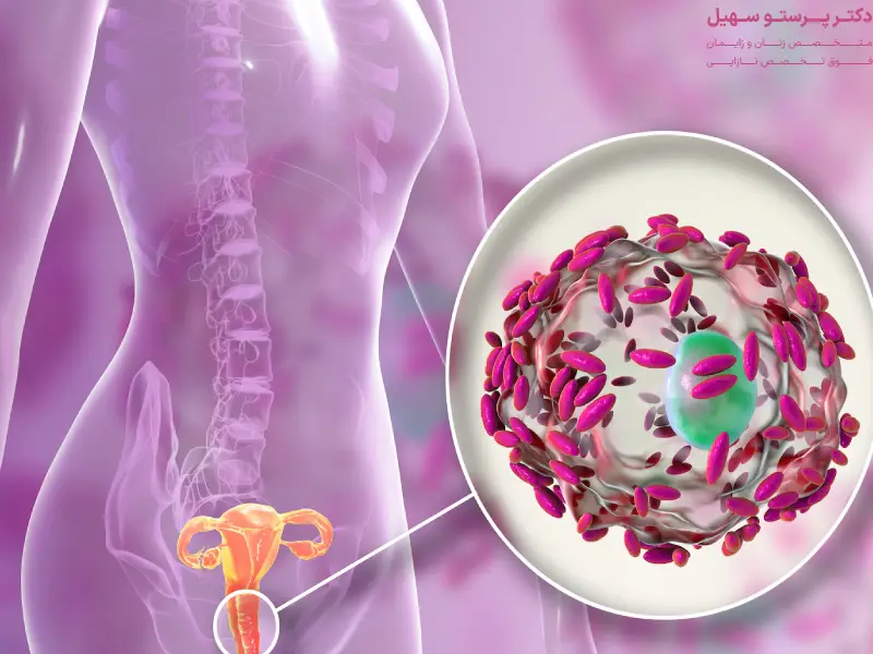 عفونت قارچی واژن