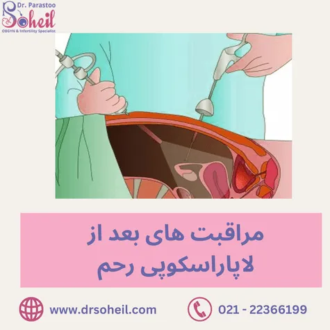 مراقبت های بعد از لاپاراسکوپی رحم