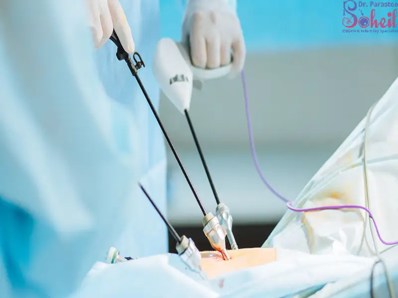 مراقبت های بعد از لاپاراسکوپی رحم