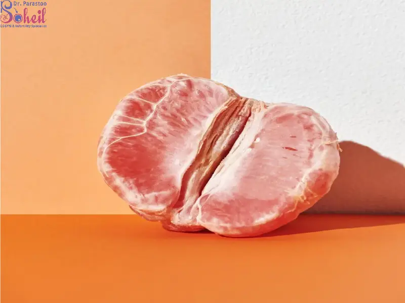 گوشت اضافه بعد از لابیاپلاستی