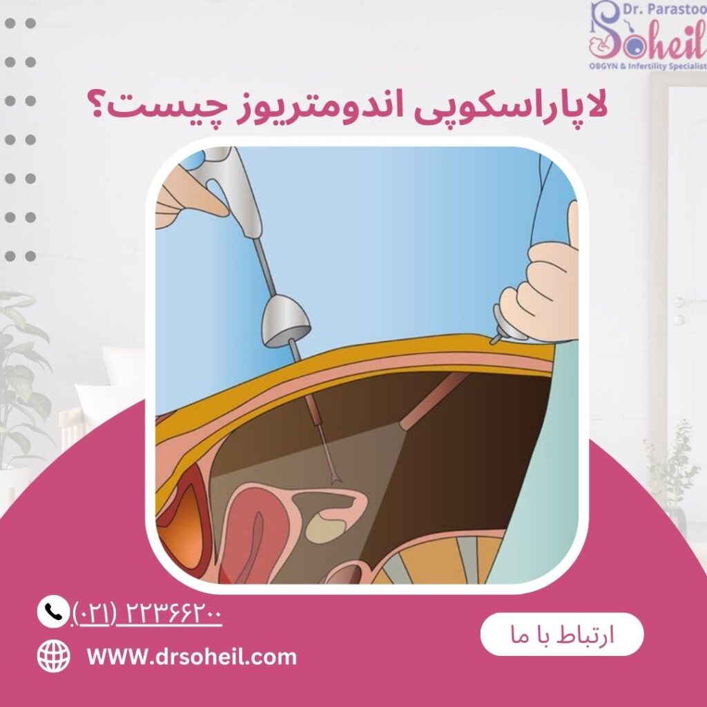 لاپاراسکوپی اندومتریوز